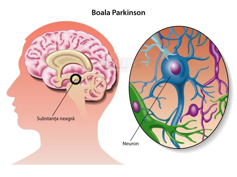 Nouă descoperire pentru tratarea bolii Parkinson