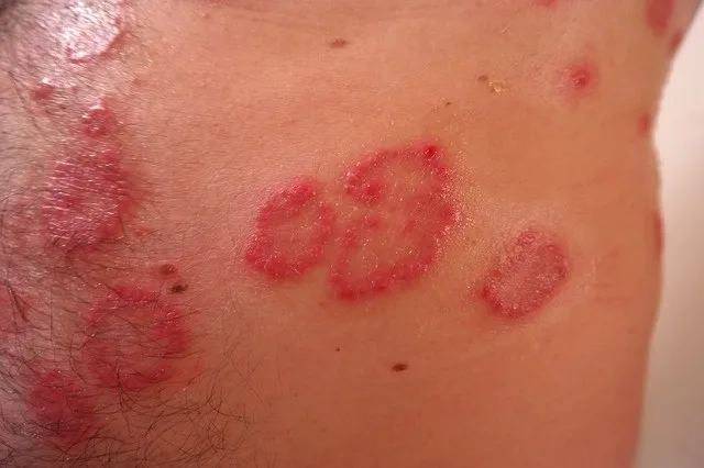 Psoriazisul, o boală incomodă şi des întâlnită