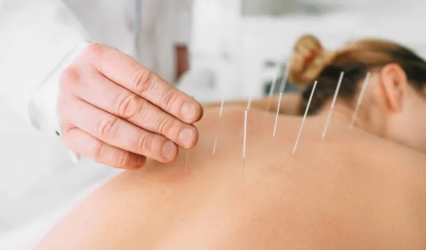 Acupunctura, o metodă asiatică de medicină naturistă