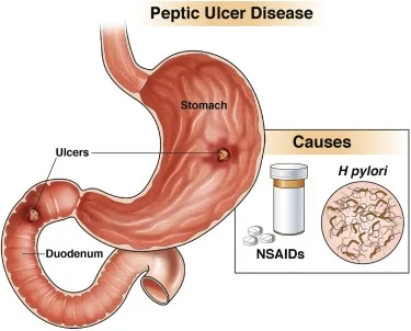 Ulcerul gastro-duodenal