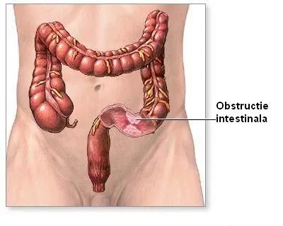 Ocluzia intestinală