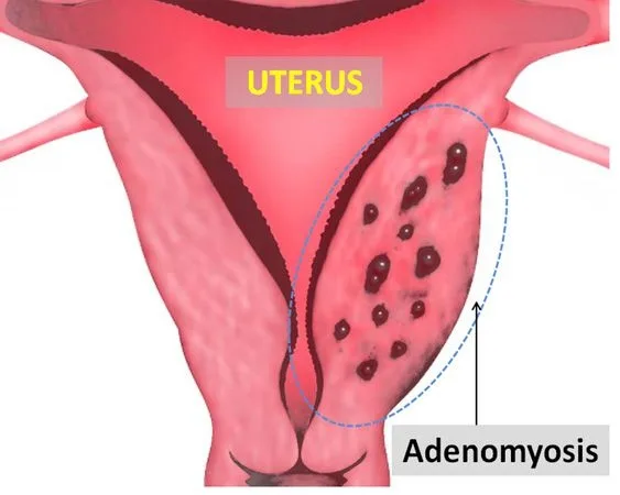 Adenomioza uterină