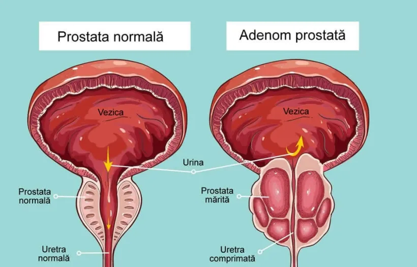 Prostata, bat-o vina!