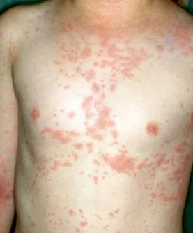 Dermatita atopică, cea mai des întâlnită boală de piele
