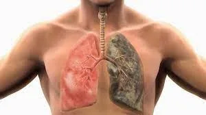 O platformă pentru afecţiunile pulmonare