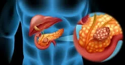 Cancerul pancreatic - o boală tăcută