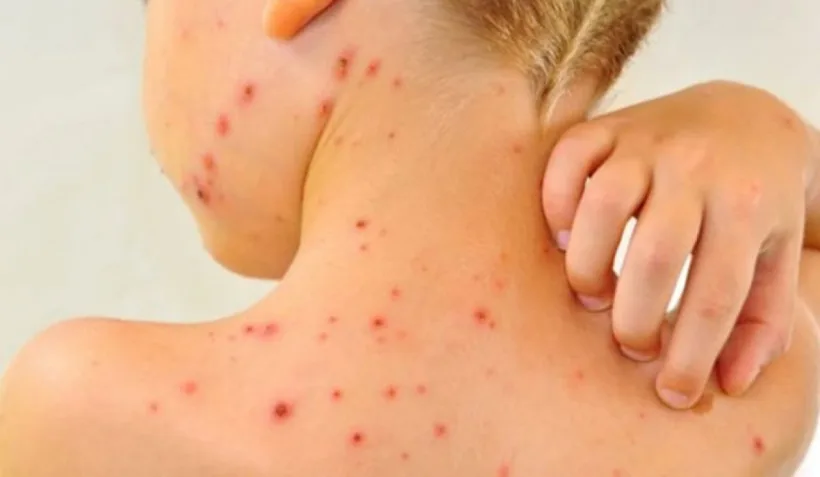 „Numărul crescut de cazuri de rujeolă, consecință a lipsei de protecție prin vaccinare”   