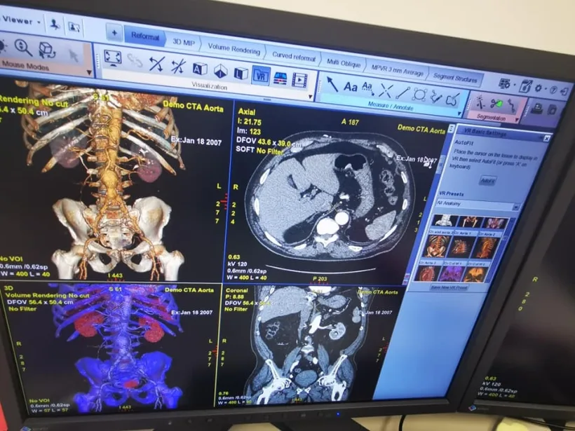 Soft pe bază de inteligență artificială pentru tratarea cancerului, la Spitalul Județean Galați   