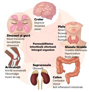 Dieta ”occidentală” duce la creșterea cazurilor de boli autoimmune în rândul populației